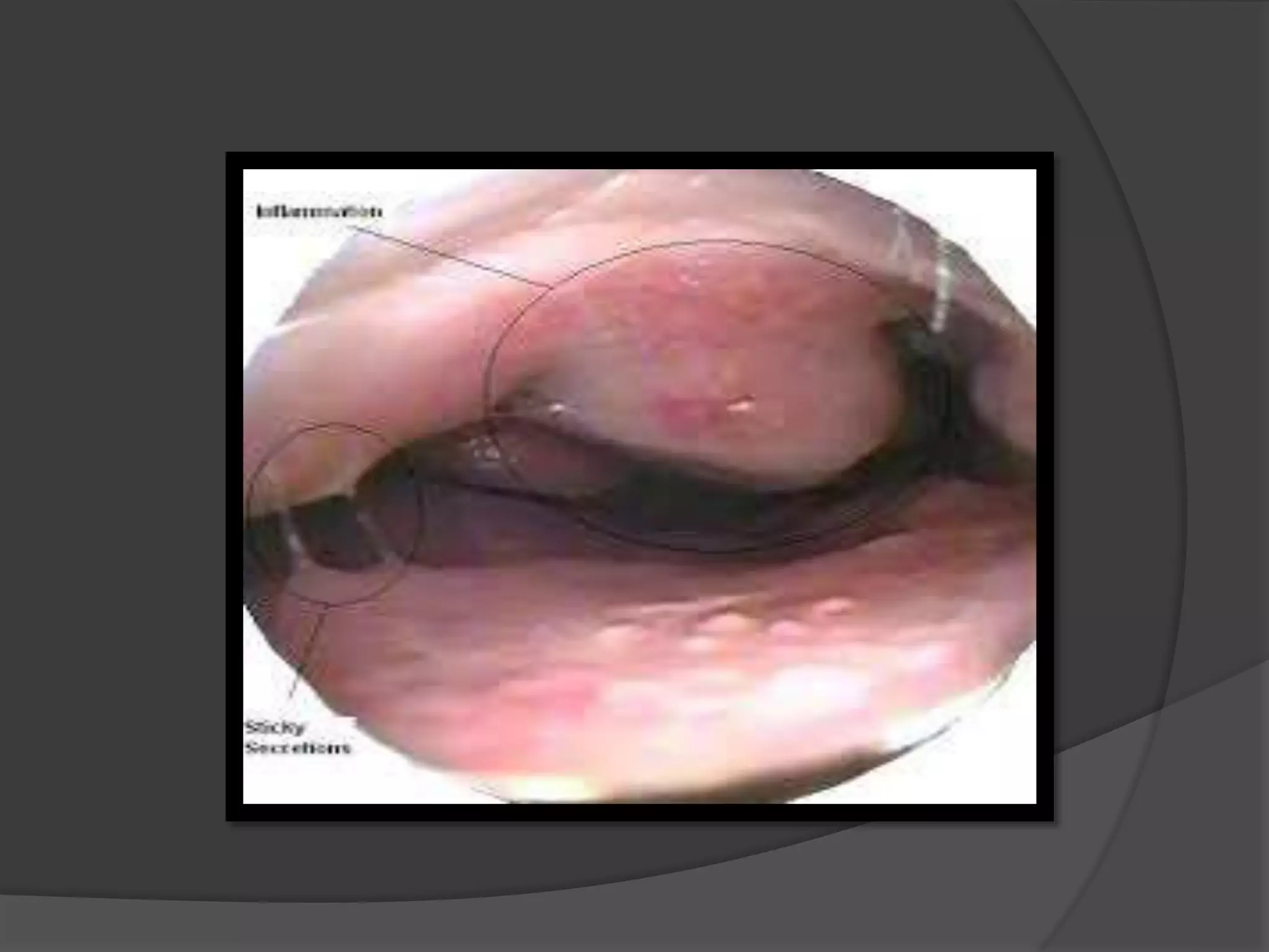 Atrophic rhinitis and Allergic rhinitis-ENT 3rd MBBS | PPTX