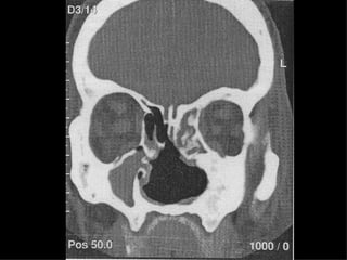 Atrophic Rhinitis Slides 050330 | PPT