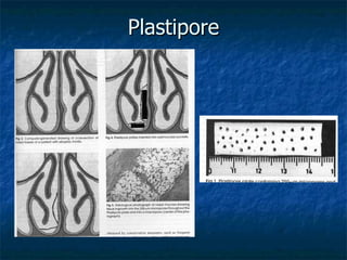 Plastipore 