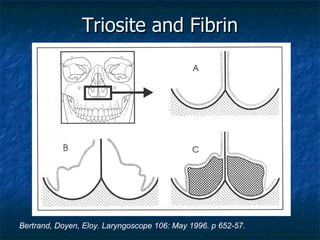 Triosite and Fibrin Bertrand, Doyen, Eloy. Laryngoscope 106: May 1996. p 652-57. 