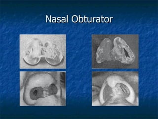 Nasal Obturator 