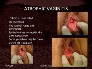 ATROPHIC VAGINITIS Introitus  contracted.  Ph  increases The vaginal rugae are diminished  Epithelium has a smooth, dry  pale appearance.  Some petechiae may be there Vulvar fat is reduced 05/01/10 maninder ahuja 
