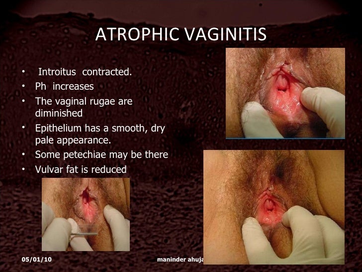atrophic vaginitis #10