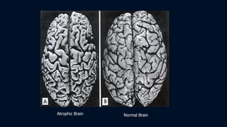 Atrophic Brain Normal Brain
 