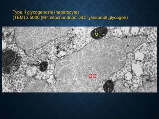Type II glycogenosis (hepatocyte)
(TEM) x 5000 (M=mitochondrion; GC: lysosomal glycogen)
M
GC
 