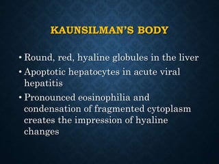 KAUNSILMAN’S BODY
• Round, red, hyaline globules in the liver
• Apoptotic hepatocytes in acute viral
hepatitis
• Pronounced eosinophilia and
condensation of fragmented cytoplasm
creates the impression of hyaline
changes
 