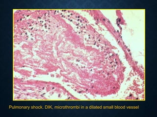 Pulmonary shock. DIK, microthrombi in a dilated small blood vessel
 