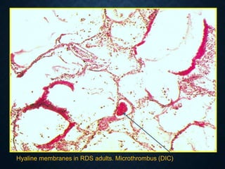 Hyaline membranes in RDS adults. Microthrombus (DIC)
 