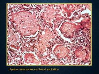 Hyaline membranes and blood aspiration
 