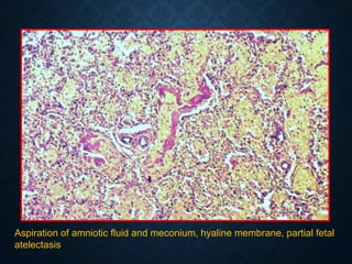 Aspiration of amniotic fluid and meconium, hyaline membrane, partial fetal
atelectasis
 