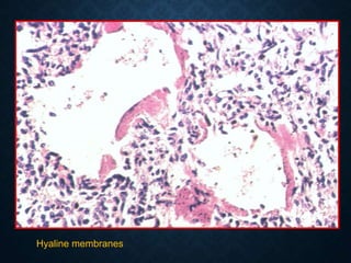 Hyaline membranes
 