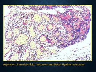 Aspiration of amniotic fluid, meconium and blood. Hyaline membrane
 