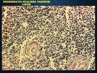 DEGENERATIO HYALINEA VASORUM
LIENIS
 