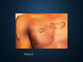 Keloid
 