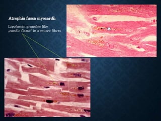 Atrophia fusca myocardii
Lipofuscin granules like
„candle flame“ in a musce fibers
 