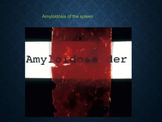 Amyloidosis of the spleen
 