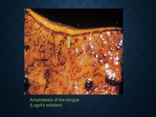Amyloidosis of the tongue
(Lugol’s solution)
 