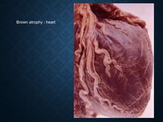 Brown atrophy : heart
 