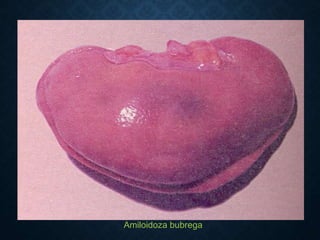 Amiloidoza bubrega
 