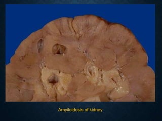 Amyiloidosis of kidney
 