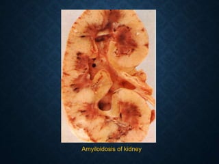 Amyiloidosis of kidney
 