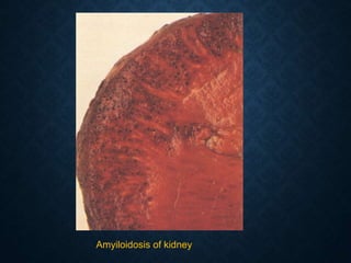 Amyiloidosis of kidney
 