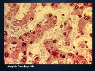 Atrophia fusca hepatitis
 