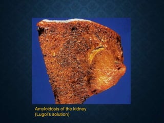 Amyloidosis of the kidney
(Lugol’s solution)
 