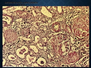 DEGENERATIO AMYLOIDEA
RENIS
 