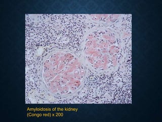 Amyloidosis of the kidney
(Congo red) x 200
 