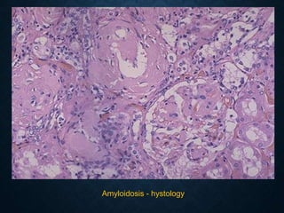 Amyloidosis - hystology
 