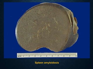 Spleen amyloidosis
 
