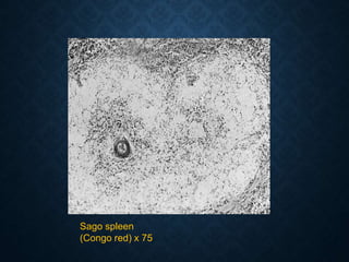 Sago spleen
(Congo red) x 75
 