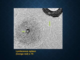 Lardaceous spleen
(Congo red) x 75
 