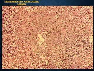 DEGENERATIO AMYLOIDEA
LIENIS
 