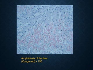 Amyloidosis of the liver
(Congo red) x 150
 