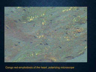 Congo red-amyloidosis of the heart, polarizing microscope
 
