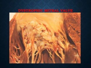 DYSTROPHIC MITRAL VALVE
CALCIFICATION
 