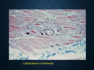 Calcifications in trichinosis
 