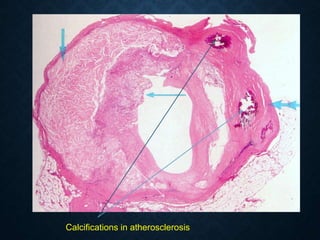 Calcifications in atherosclerosis
 