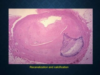 Recanalization and calcification
 