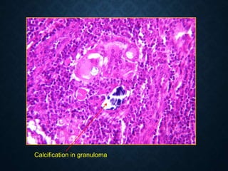 Calcification in granuloma
 