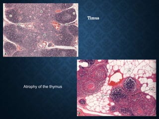 Timus
Atrophy of the thymus
 