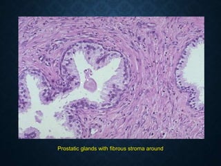 Prostatic glands with fibrous stroma around
 