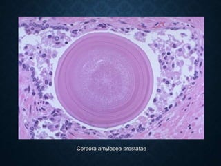Corpora amylacea prostatae
 