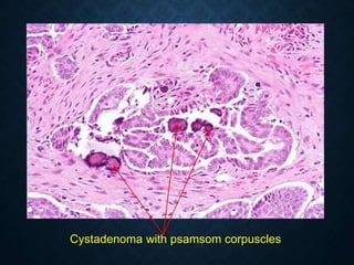 Cystadenoma with psamsom corpuscles
 