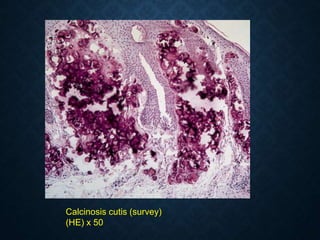 Calcinosis cutis (survey)
(HE) x 50
 
