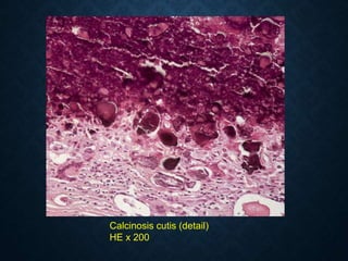 Calcinosis cutis (detail)
HE x 200
 