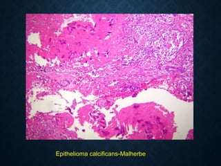 Epithelioma calcificans-Malherbe
 