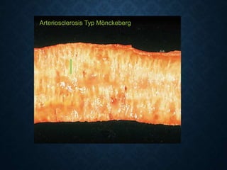 Arteriosclerosis Typ Mönckeberg
 